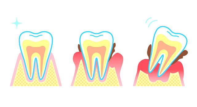 歯周病の進行j